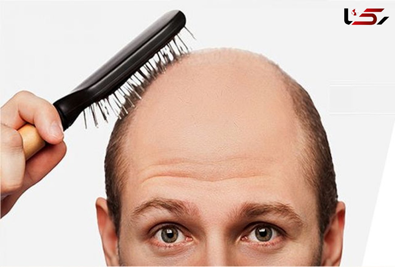 ریزش مو چه دلایلی دارد؟