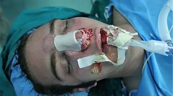 فاجعه در اتاق عمل تقلبی/ دیپلمه‌ای که خودش را «جراح ۳هزار بینی» جا زد!