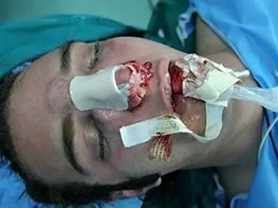 جراحی بینی بدون بیهوشی توسط جوان دیپلمه / مدعی 3 هزار جراحی موفقیت آمیز است