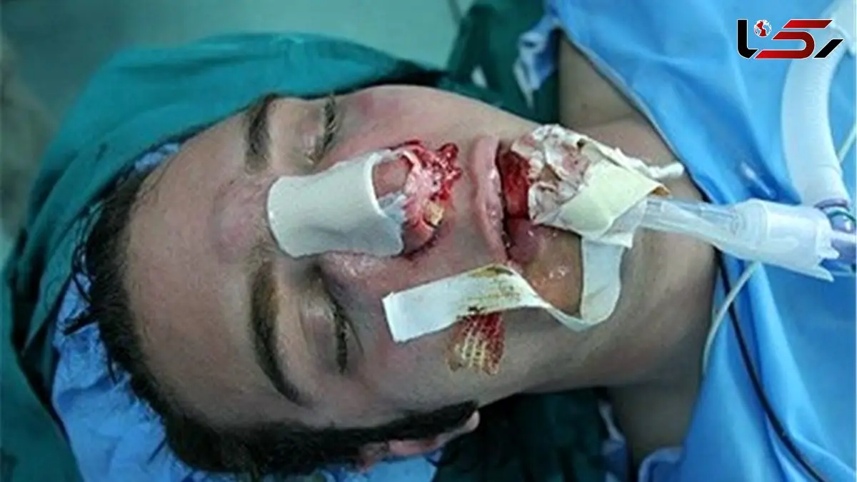 جراحی بینی بدون بیهوشی توسط جوان دیپلمه / مدعی 3 هزار جراحی موفقیت آمیز است