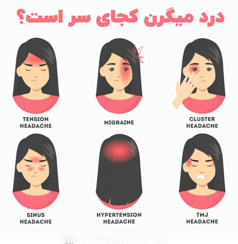 میگرن