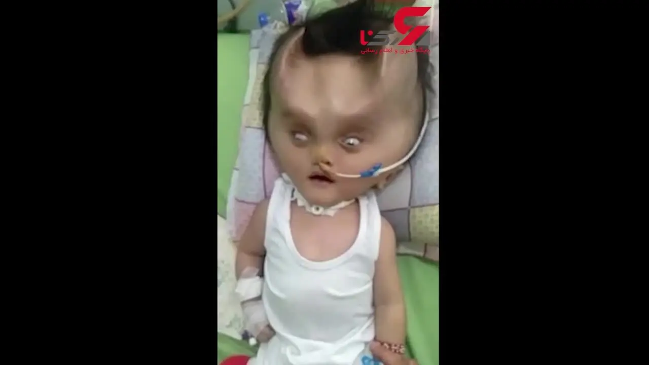 تغییر شکل عجیب صورت نوزاد پس از عمل جراحی! +فیلم