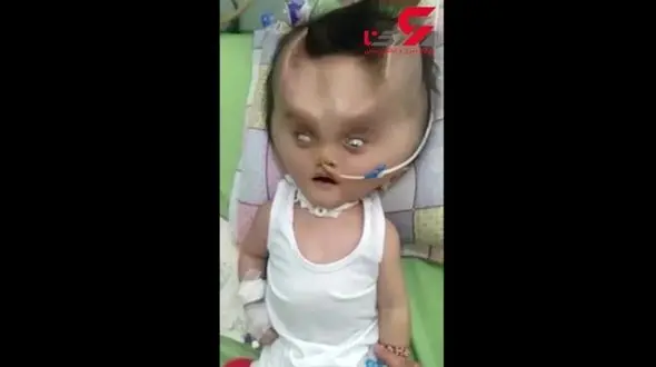 تغییر شکل عجیب صورت نوزاد پس از عمل جراحی! +فیلم