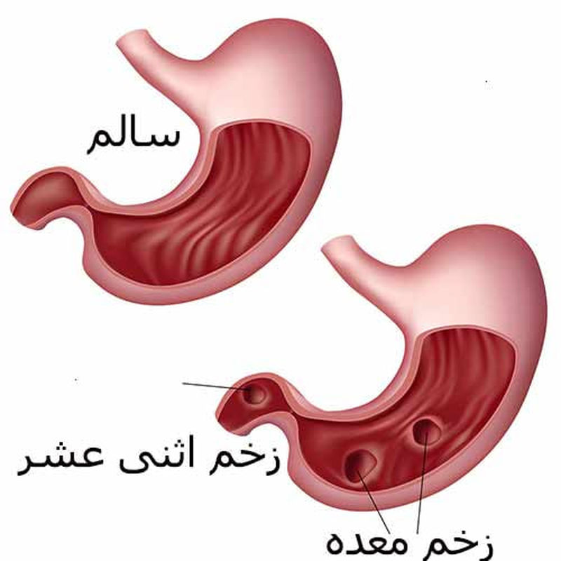 زخم معده زخم اثنی عشر