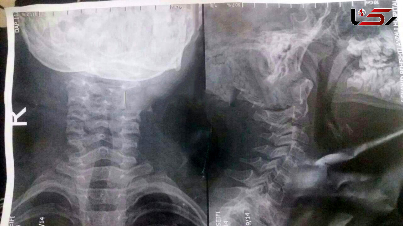 گیر کردن استخوان ماهی در گلوی کودک ۸ ساله گیلانی او را تا پای تیغ جراحی برد +عکس