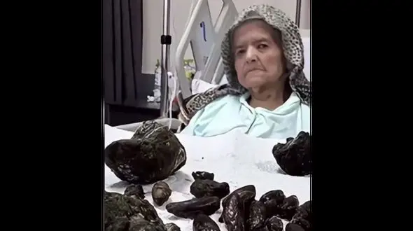 خروج ۲۸ هسته خرما، ۳۵ هسته زیتون و ۵ سنگ از معده زن ۹۲ ساله+ فیلم