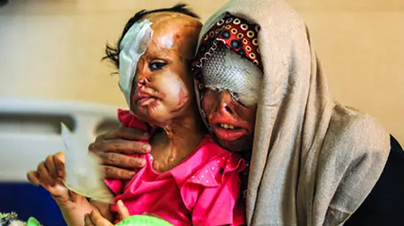 3 زن و مرد اسیدسوخته بالاخره لبخند زدند! / علت خوشحالی آنها چه بود؟ + تصاویر