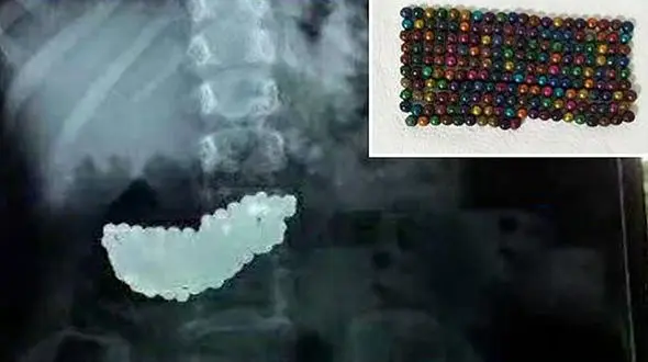 شکم برآمده دختر 5 ساله شوک آور بود! + عکس / چین 