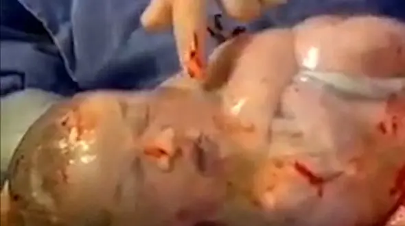 فیلم دیدنی و جالب از لحظه تولد نوزاد داخل کیسه آب مادر