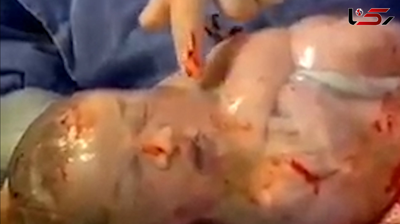 فیلم دیدنی و جالب از لحظه تولد نوزاد داخل کیسه آب مادر