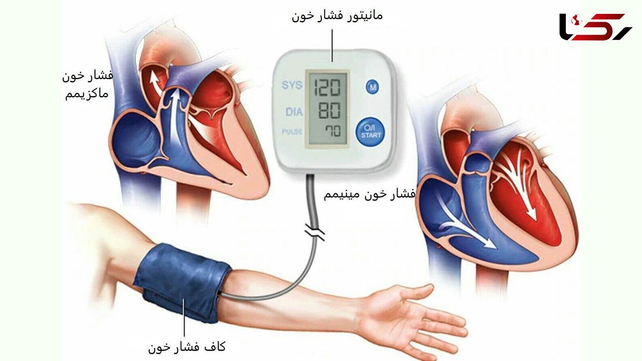 یافته‌های مهم درباره فشار خون بالا 