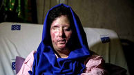 سهیلا قربانی اسیدپاشی : آسمانم سیاه شده است +عکس