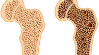 پوکی استخوان را با این غذاها از خود دور کنید