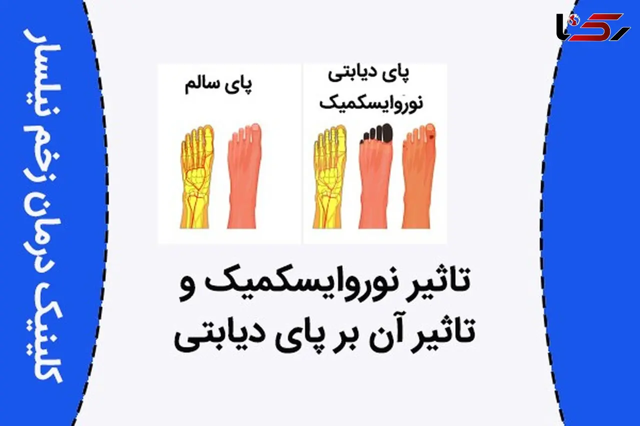 تاثیر نوروایسکمیک و تاثیر آن بر پای دیابتی 