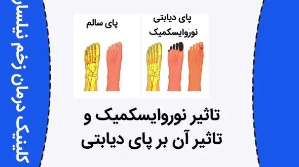 تاثیر نوروایسکمیک و تاثیر آن بر پای دیابتی 