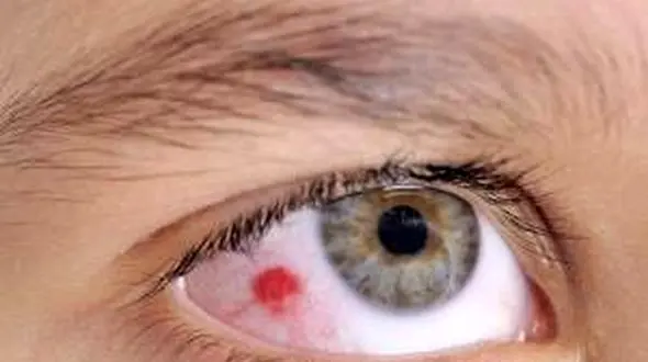  لکه قرمز داخل چشم خبر از چه بیماری می دهد؟