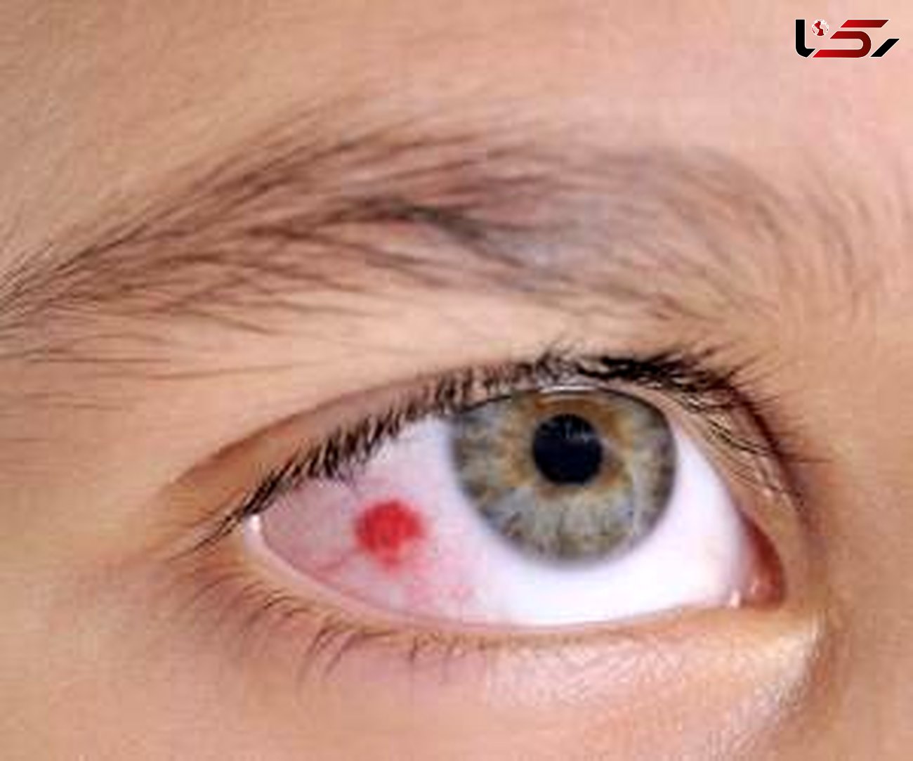  لکه قرمز داخل چشم خبر از چه بیماری می دهد؟