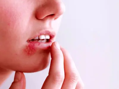 آیا می‌توان از شر تبخال به‌طور دائمی خلاص شد؟ 