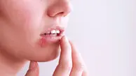 آیا می‌توان از شر تبخال به‌طور دائمی خلاص شد؟ 