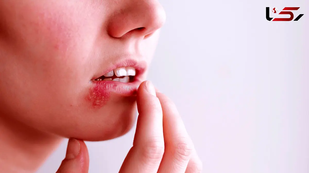 آیا می‌توان از شر تبخال به‌طور دائمی خلاص شد؟ 