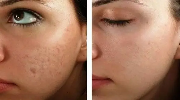 کلاژن‌سازی با میکرونیدلینگ برای درمان آکنه