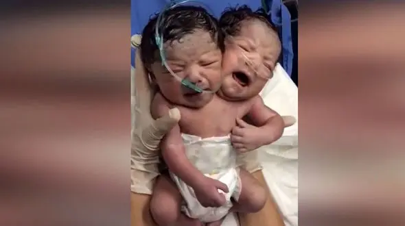 تولد نوزاد عجیب الخلقه با 2 سر از تازه عروس عرب + عکس