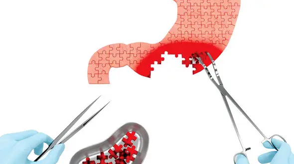 سرطان معده چطور به زنان و مردان حمله می کند؟