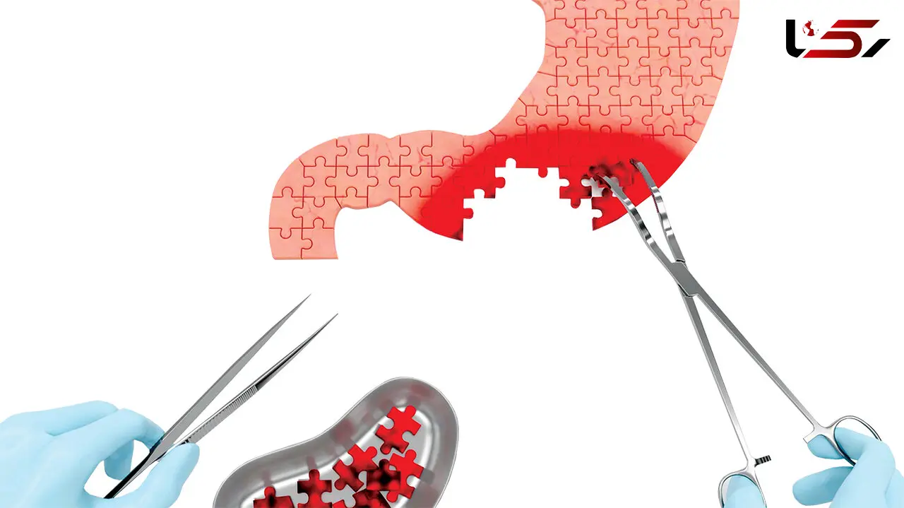 سرطان معده چطور به زنان و مردان حمله می کند؟