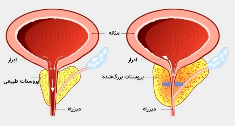 پروستات