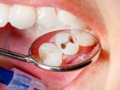 راهکارهای طلایی برای پیشگیری از افتادن دندان‌ ها با افزایش سن
