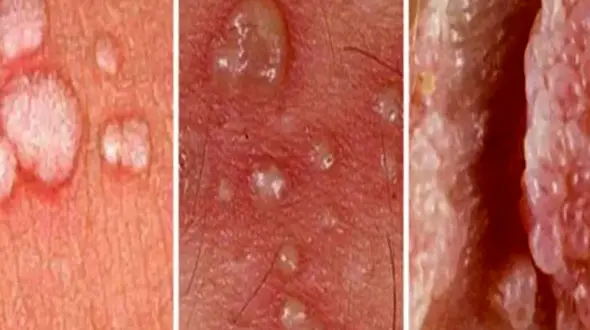 زگیل چیست؟ + روش از بین بردن زگیل تناسلی در زنان و مردان