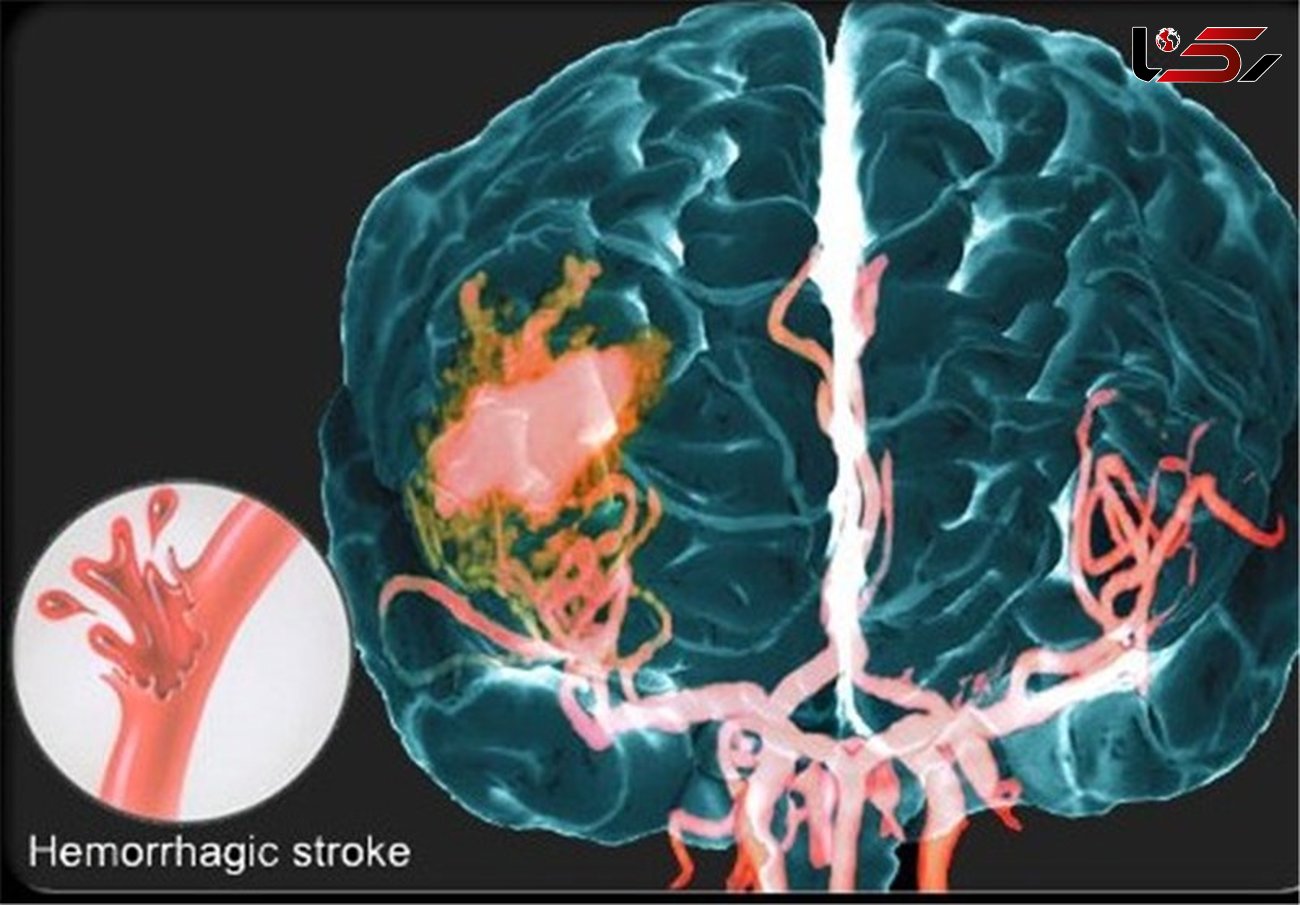 درمان سکته مغزی با روشی جدید