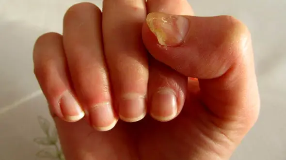 بلایی که ناخن کاشت سرتان می آورد / راهکار پیشگیری و درمان قارچ کاشت ناخن + فیلم