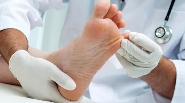 راه های درمان زگیل پا