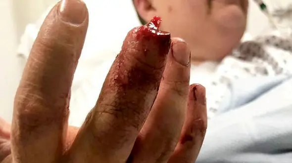 سگ وحشی انگشت دست مرد پستچی را خورد!+تصاویر(14+)