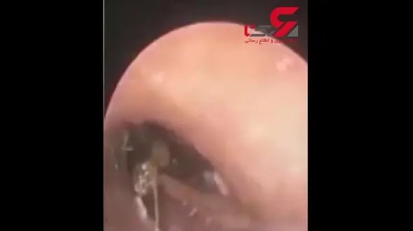 بیرون کشیدن سوسک زنده از گوش مرد چینی + تصویر
