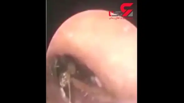 بیرون کشیدن سوسک زنده از گوش مرد چینی + تصویر