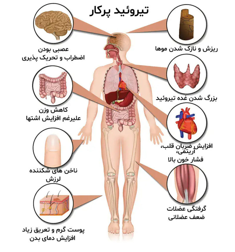 تیروئید پرکار