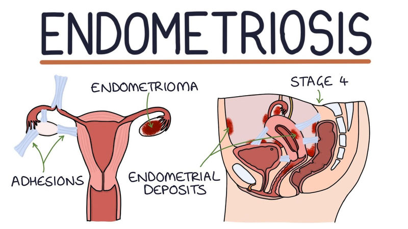 آندومتریوز چیست