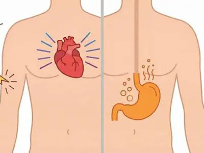 حمله قلبی یا رفلاکس معده؟ چگونه تفاوت این 2 را تشخیص دهیم؟