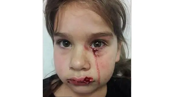 حمله وحشیانه سگ به یک دختر 5 ساله+عکس