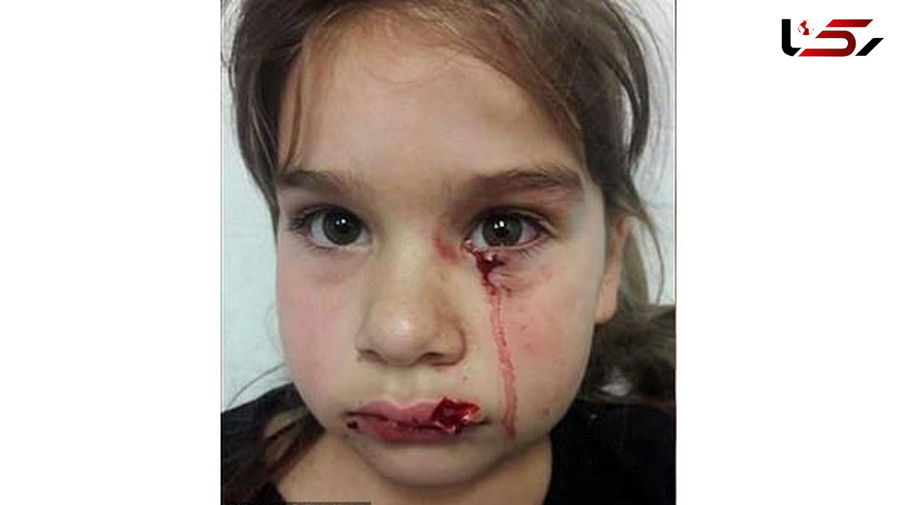 حمله وحشیانه سگ به یک دختر 5 ساله+عکس