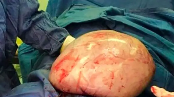 8 کیلو گرم توده اضافه از بدن بیمار گچسارانی خارج شد