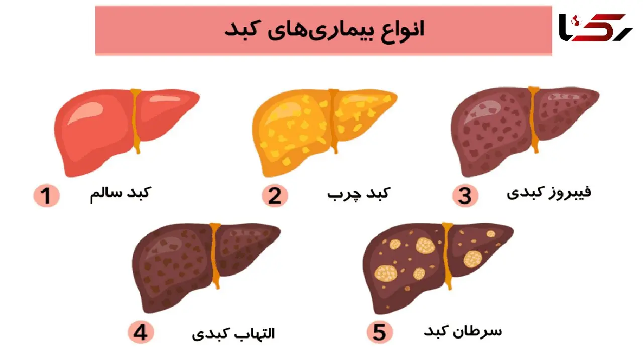 14 مورد از رایج ترین علائم کبد چرب