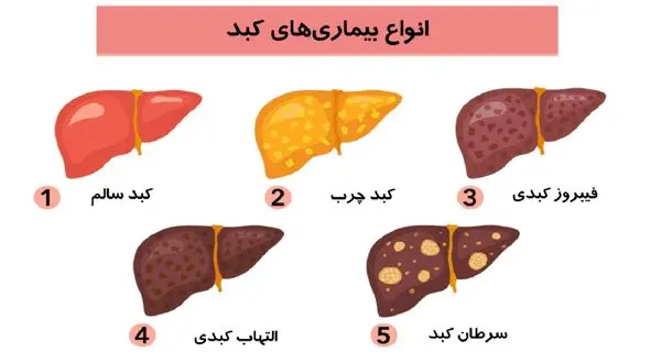 14 مورد از رایج ترین علائم کبد چرب