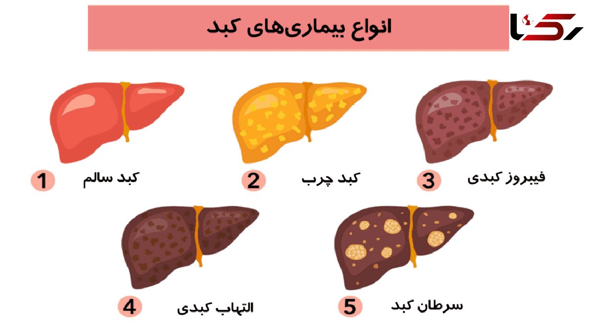  14 مورد از رایج ترین علائم کبد چرب 
