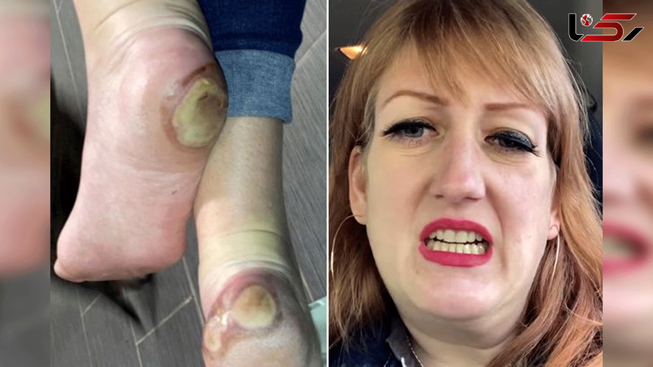 Anti-vaxxers are using a photo of a Covid vaccine trial patient's foot to spread fake news