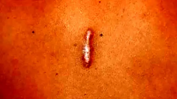 راز درمان کلوئید؛ از راهکارهای خانگی تا پزشکی