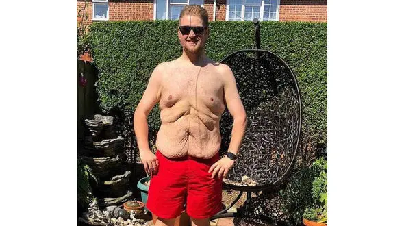  چندش آورترین و زشت ترین شکم  دنیا+عکس