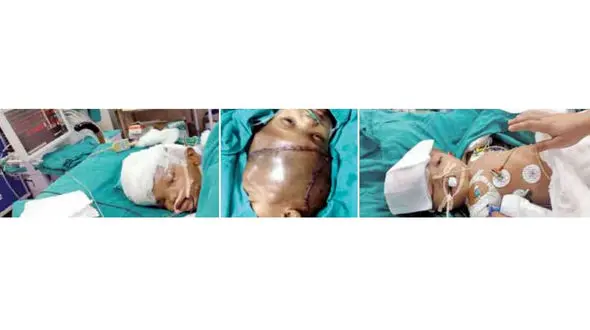 جراحی 36 ساعته برای جدایی دوقلوها + عکس